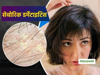 सिर और त्वचा पर पीली पपड़ी या पर्त हो सकती है 'सेबोरिक डर्मेटाइटिस' का संकेत', जानें कारण और लक्षण